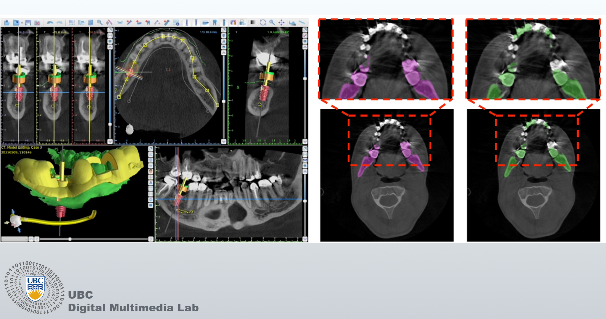 Digital Health and AI: Improving CBCT Image Quality | UBC Digital ...